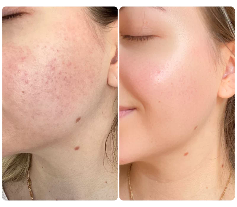 Taie d'oreiller en soie Remède naturel anti-rougeurs visage et rosacée