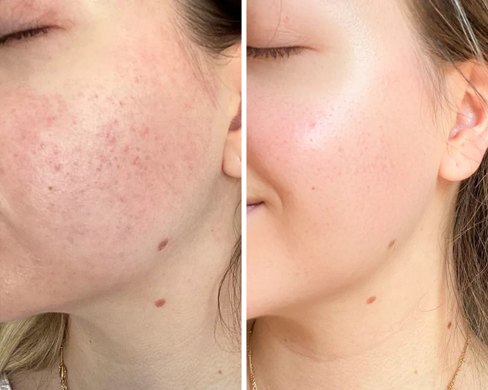 Résultats avant et après l’utilisation d’une taie d’oreiller en soie Gaïanne, montrant une peau apaisée et plus lisse.